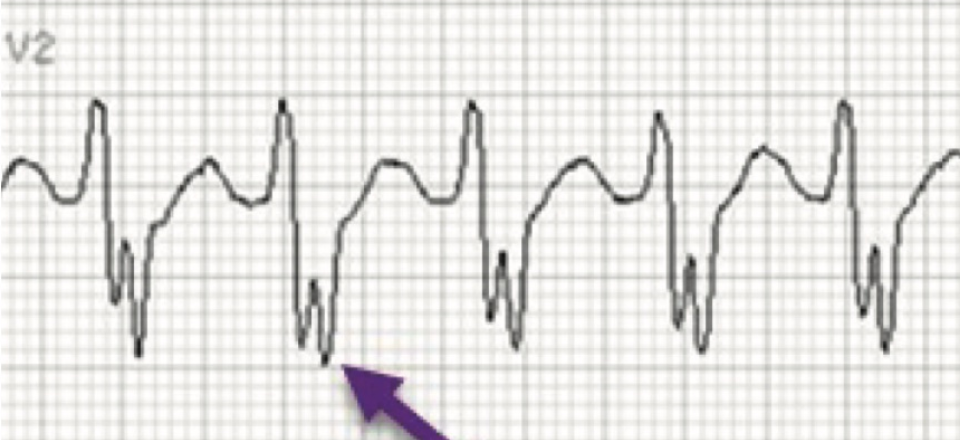 Wide Complex Tachycardias: Making the Brugada Criteria More User Friendly
